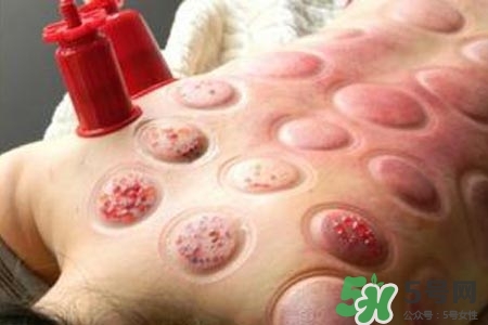 拔罐放血對身體好嗎？拔罐放血有什么好處？