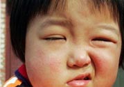 如何預(yù)防面癱復(fù)發(fā)？導(dǎo)致面癱的四大原因
