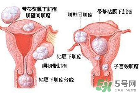 子宮小會(huì)影響生育嗎？子宮小會(huì)導(dǎo)致不孕嗎？