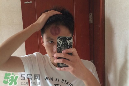 拔罐后皮膚癢能撓嗎？拔罐后身上癢切忌抓撓