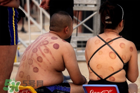 拔罐后可以泡澡嗎？拔罐后多久能泡澡？