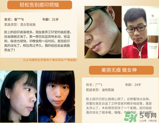 芷軒堂祛痘有效果嗎？芷軒堂祛痘印效果怎么樣？