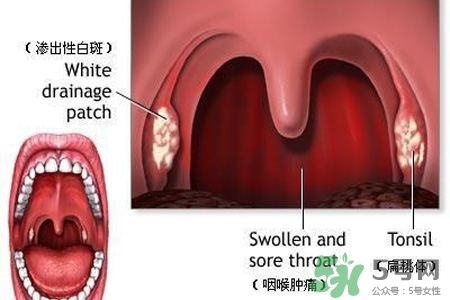 口含大蒜能治療咽炎嗎？巧用大蒜治療咽炎咳嗽