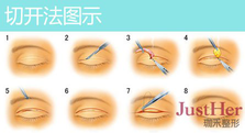 定點雙眼皮怎么做？定點雙眼皮需要拆線嗎？