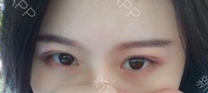 定點(diǎn)雙眼皮能保持多久？定點(diǎn)雙眼皮是永久的嗎？