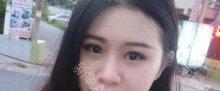 定點(diǎn)雙眼皮能保持多久？定點(diǎn)雙眼皮是永久的嗎？