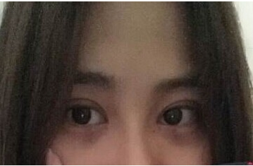 定點雙眼皮怎么做？定點雙眼皮需要拆線嗎？