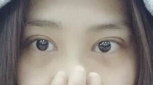 定點雙眼皮怎么做？定點雙眼皮需要拆線嗎？