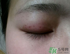 埋線雙眼皮需要拆線嗎？埋線雙眼皮怎么拆線