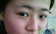 埋線雙眼皮需要拆線嗎？埋線雙眼皮怎么拆線
