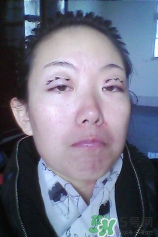 什么是定點(diǎn)雙眼皮？定點(diǎn)雙眼皮多少錢(qián)？