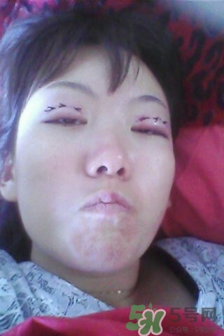 什么是定點(diǎn)雙眼皮？定點(diǎn)雙眼皮多少錢(qián)？