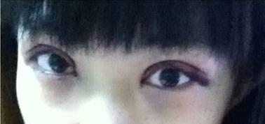 韓式三點(diǎn)雙眼皮是永久嗎？三點(diǎn)雙眼皮能保持多久？