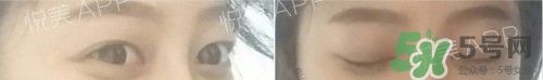埋線雙眼皮多久恢復(fù)自然？埋線雙眼皮多久能恢復(fù)