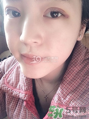 什么是定點(diǎn)雙眼皮？定點(diǎn)雙眼皮多少錢(qián)？