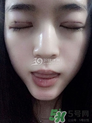 什么是定點(diǎn)雙眼皮？定點(diǎn)雙眼皮多少錢(qián)？
