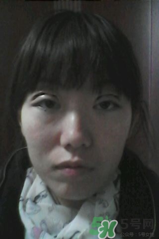 什么是定點(diǎn)雙眼皮？定點(diǎn)雙眼皮多少錢(qián)？