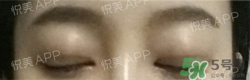 埋線雙眼皮多久恢復(fù)自然？埋線雙眼皮多久能恢復(fù)