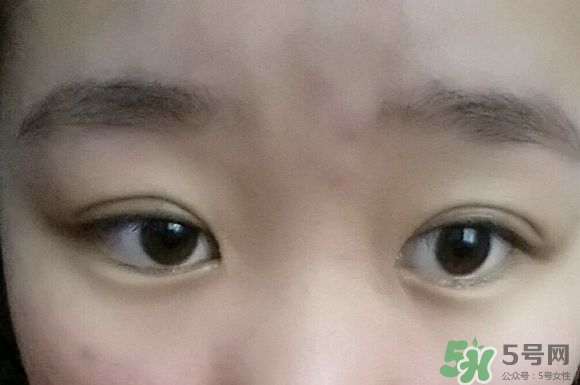 埋線雙眼皮需要拆線嗎？埋線雙眼皮怎么拆線