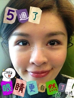 重瞼術(shù)是什么？重瞼術(shù)是永久的嗎？