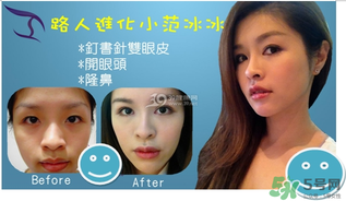 重瞼術(shù)是什么？重瞼術(shù)是永久的嗎？