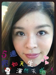 重瞼術(shù)是什么？重瞼術(shù)是永久的嗎？