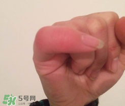 小拇指凍腫了怎么辦？為什么小拇指容易凍？