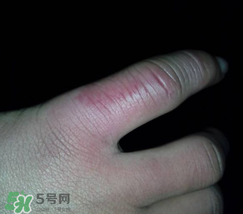 小拇指凍腫了怎么辦？為什么小拇指容易凍？