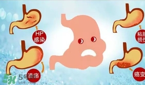 神經(jīng)性胃痙攣是什么？神經(jīng)性胃痙攣是什么原因？