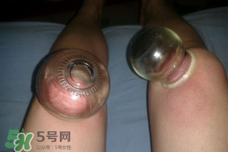 拔罐瘦腿真的有效嗎？腿部拔火罐減肥效果好嗎？
