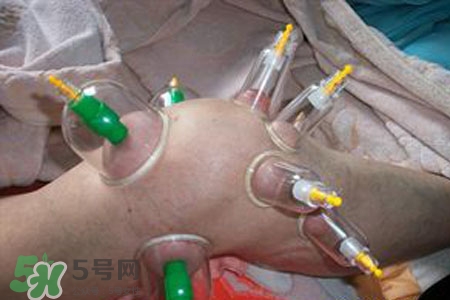 小腿能拔罐嗎？在小腿上拔火罐有什么作用？