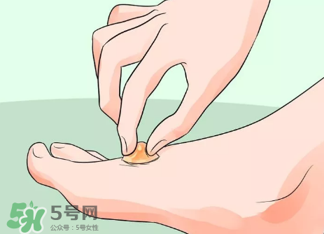 水泡怎么處理？水泡要不要刺破？