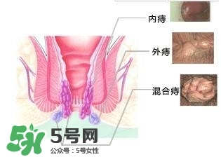 痔瘡吃什么藥效果好？痔瘡吃什么藥好得快？