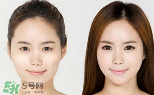 瘦臉針分為幾種類型？瘦臉針有哪幾個牌子？
