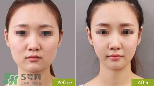 瘦臉針分為幾種類型？瘦臉針有哪幾個牌子？
