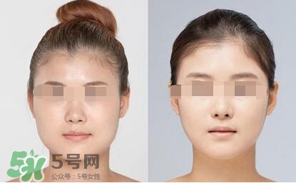 瘦臉針分為幾種類型？瘦臉針有哪幾個牌子？