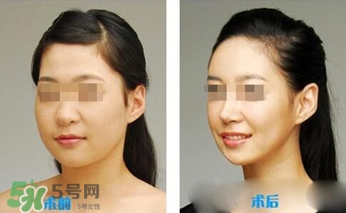 瘦臉針分為幾種類型？瘦臉針有哪幾個牌子？