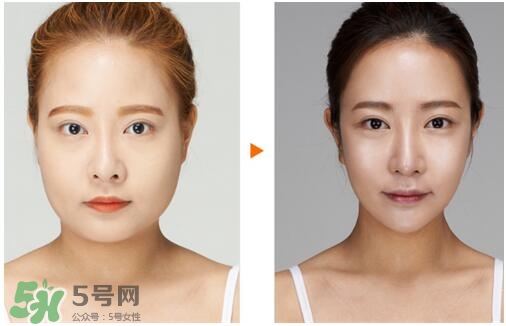 瘦臉針分為幾種類型？瘦臉針有哪幾個牌子？