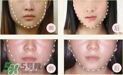 打完瘦臉針多久可以化妝？打完瘦臉針的反應(yīng)
