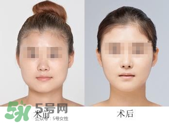 打瘦臉針能喝酒嗎？打瘦臉針能吃海鮮嗎？