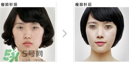 打瘦臉針能喝酒嗎？打瘦臉針能吃海鮮嗎？