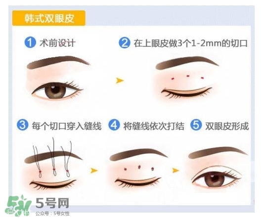 割雙眼皮有幾種做法？雙眼皮有哪幾種形狀？