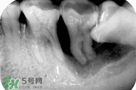 智齒會引起耳鳴嗎？耳鳴跟智齒有關(guān)系嗎？
