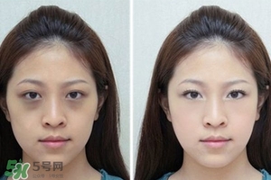 臥蠶是黑眼圈嗎？臥蠶和黑眼圈的區(qū)別