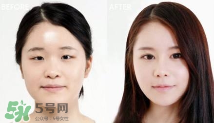割雙眼皮有什么后遺癥嗎？割雙眼皮有什么危害性？