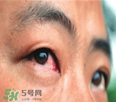 紅眼病是怎么引起的？紅眼病怎么產(chǎn)生的