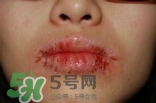 嘴唇干燥是什么原因？嘴唇干裂脫皮怎么辦？