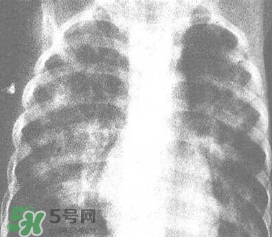 紅眼病是怎么引起的？紅眼病怎么產(chǎn)生的