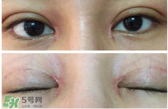 眼角增生是什么意思？眼角增生了怎么辦？