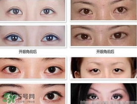 哪些人需要開眼角？需要開眼角的眼睛圖片